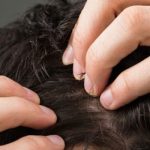 Hair loss treatment to help the hair fall and promote hair growth
