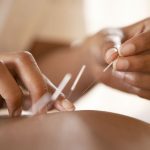 What is acupuncture and how it works?